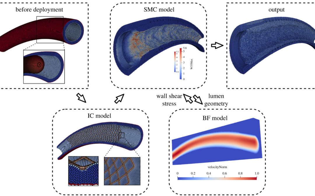 Uncertainty quantification of a three-dimensional in-stent restenosis model with surrogate modelling
