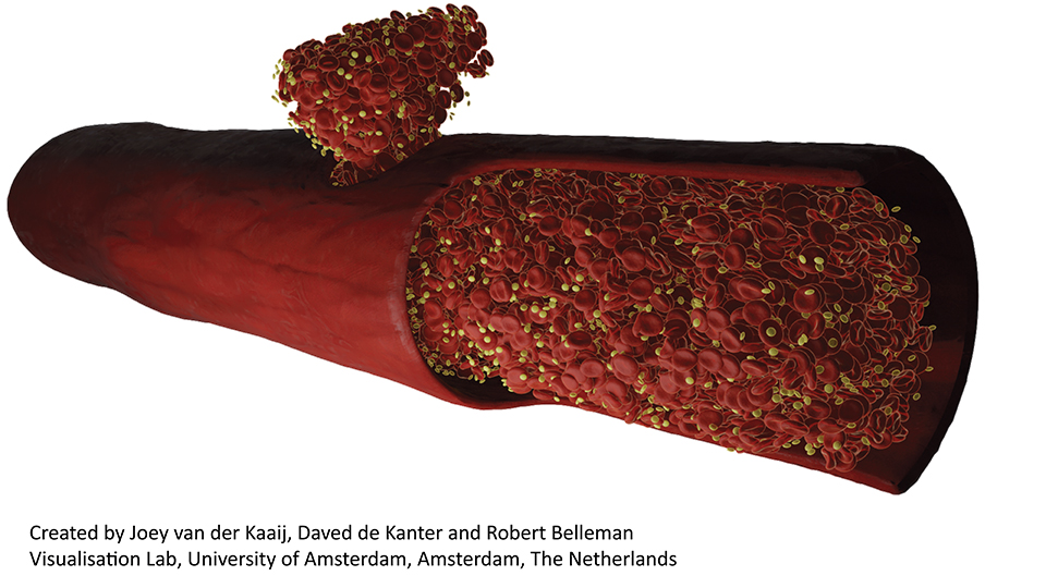 Simulating blood clot beginnings